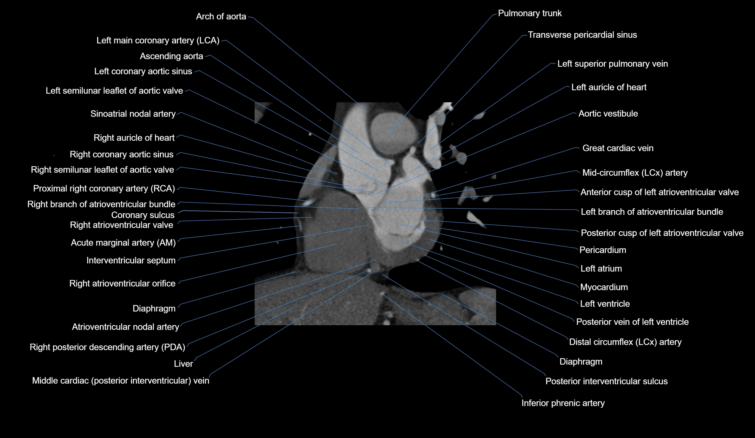 CT heart (coronary angiogram) short axis view  cross sectional anatomy labelled radiology image-00021.webp